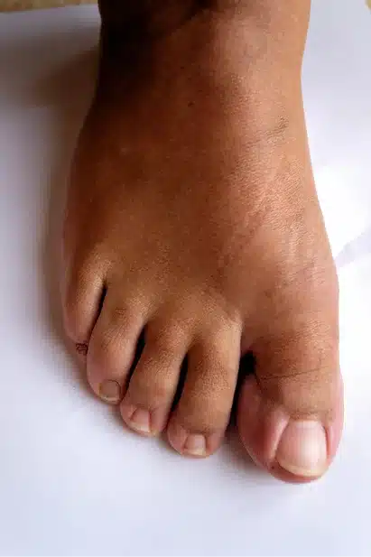 patients bare foot