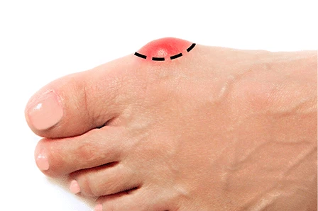 bare foot with a red bunion outlined by a dashed line