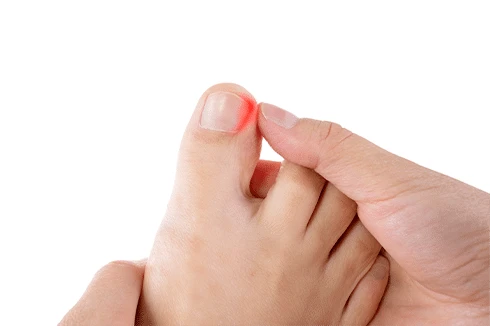 bare foot with an ingrown toenailv