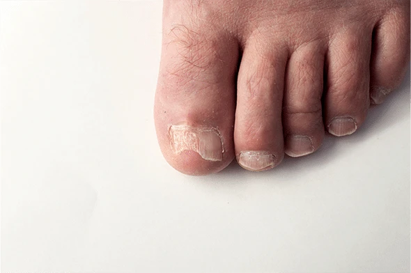 bare foot with toe fungus