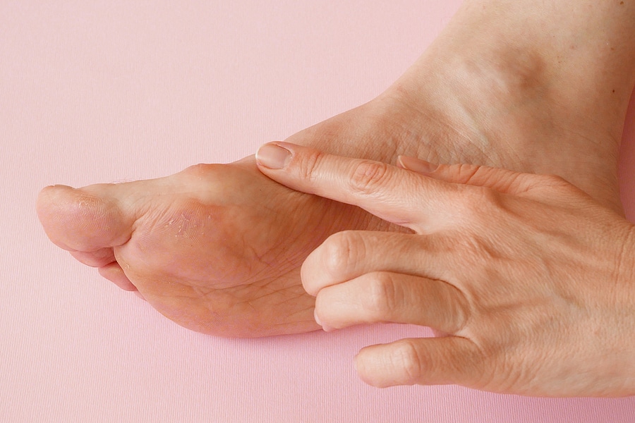 How Do I Know If I Have a Bunion?