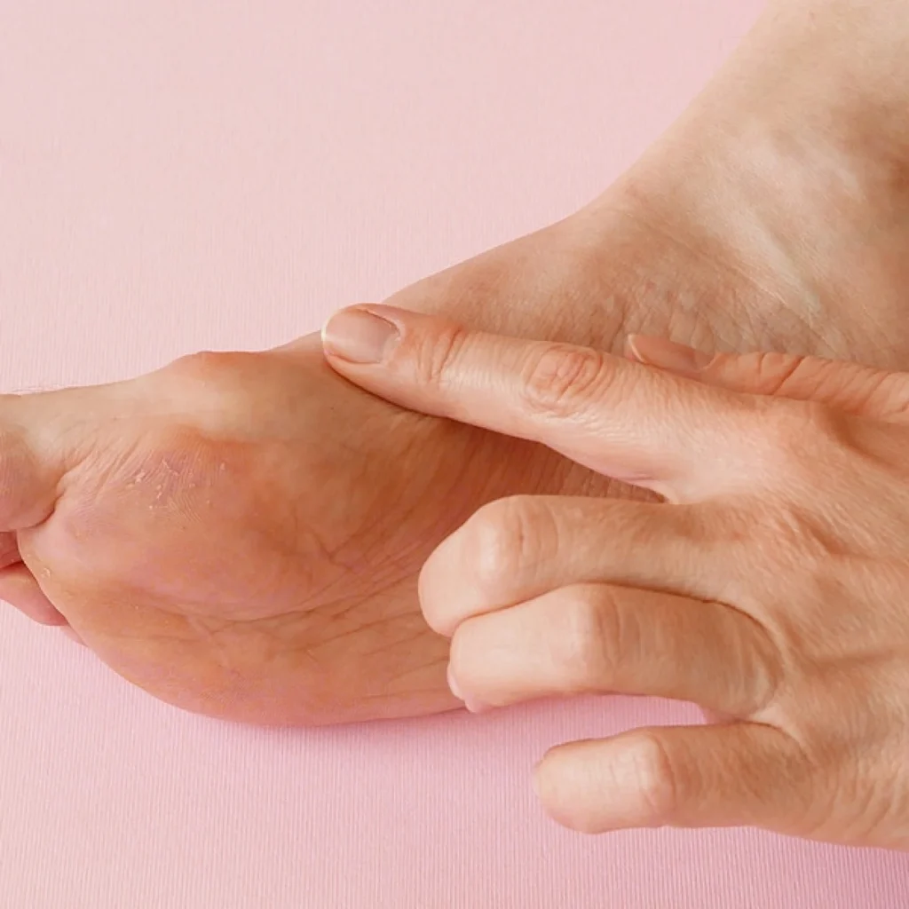 Woman's Hand Massaging Her Bunion Toes I