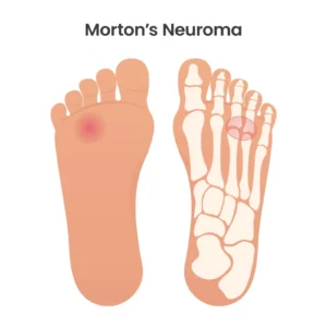 Morton Neuroma