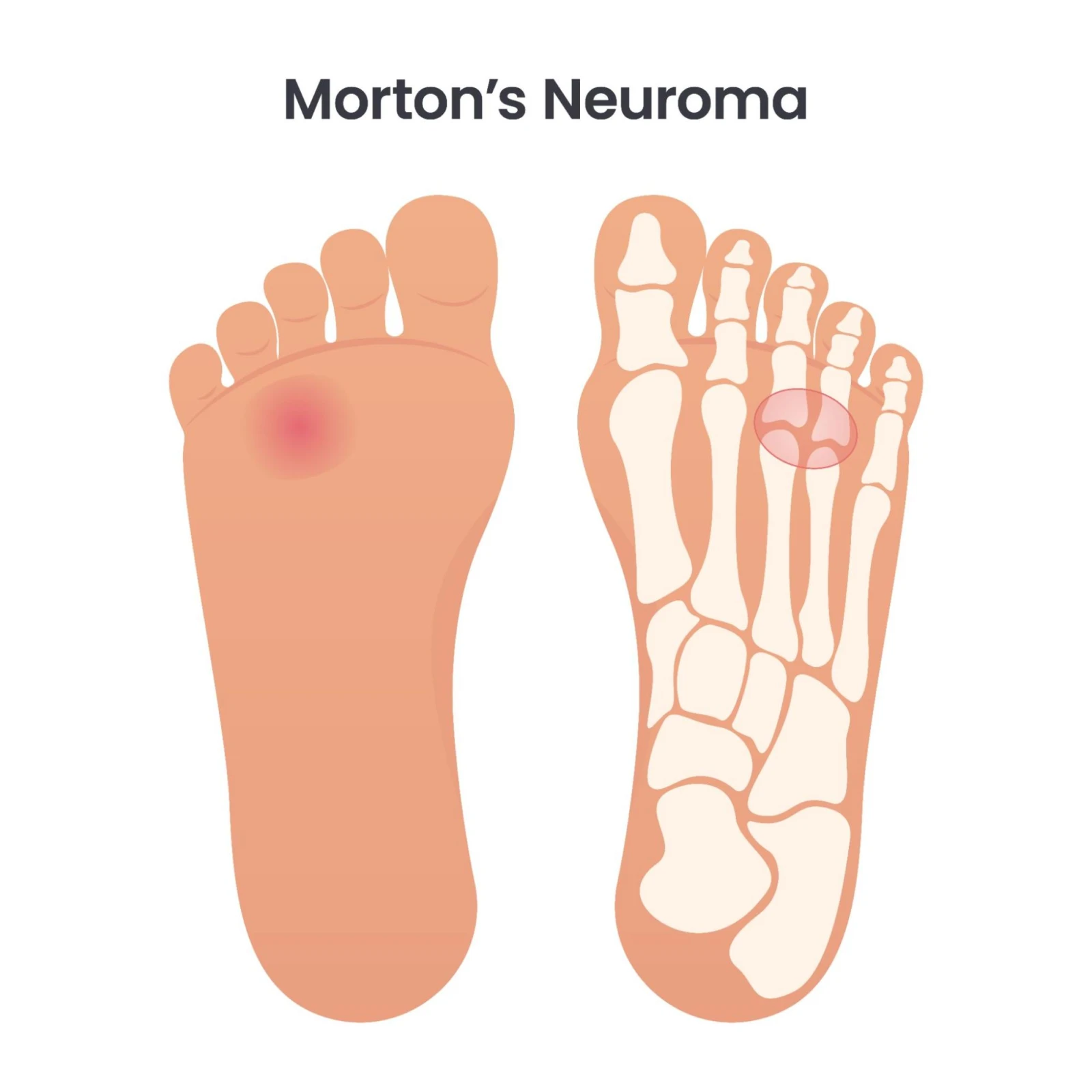 10 Signs You May Have Morton’s Neuroma
