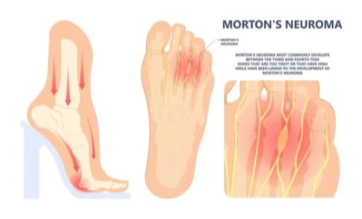 foot with morton's neuroma
