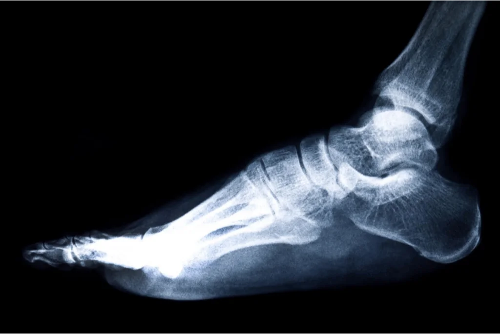 X-ray of a foot, showing bones and structure, commonly used to diagnose foot problems.