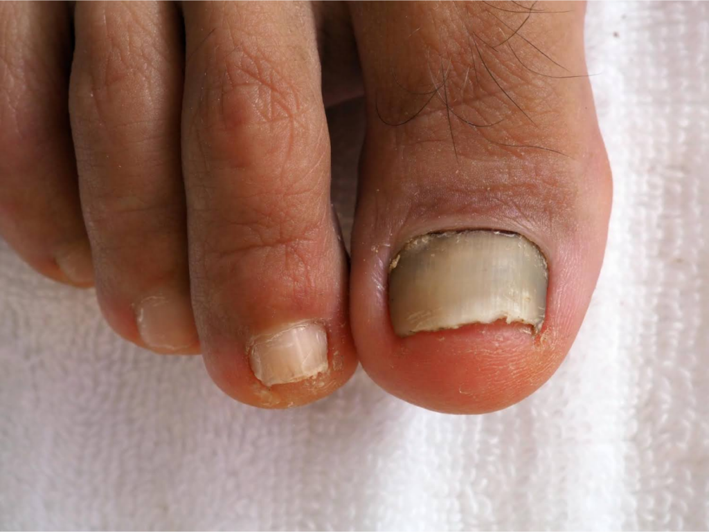 Toenail with discoloration and thickening caused by fungal infection.