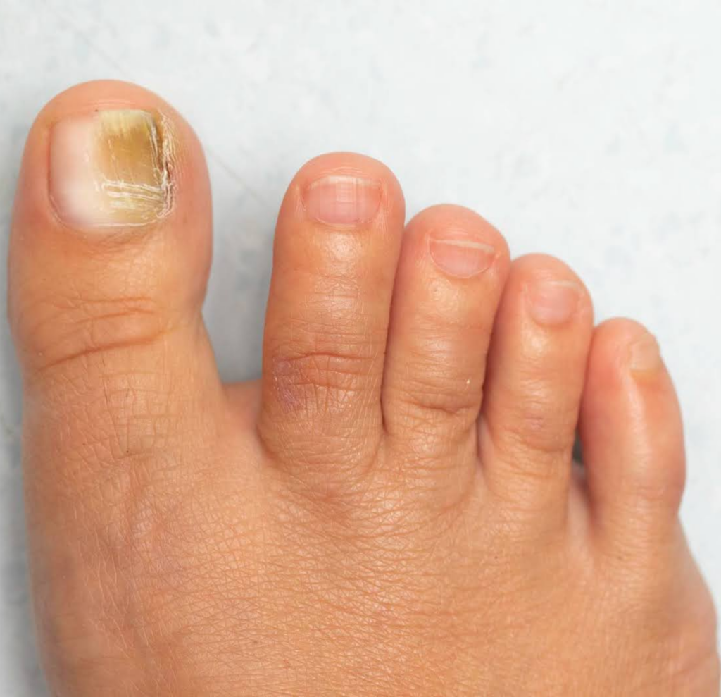 How Can a Podiatrist Treat My Toenail Fungus?