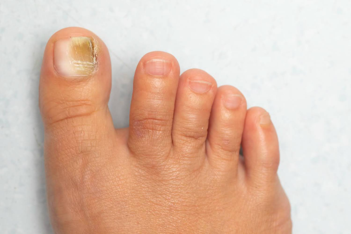 How Can a Podiatrist Treat My Toenail Fungus?