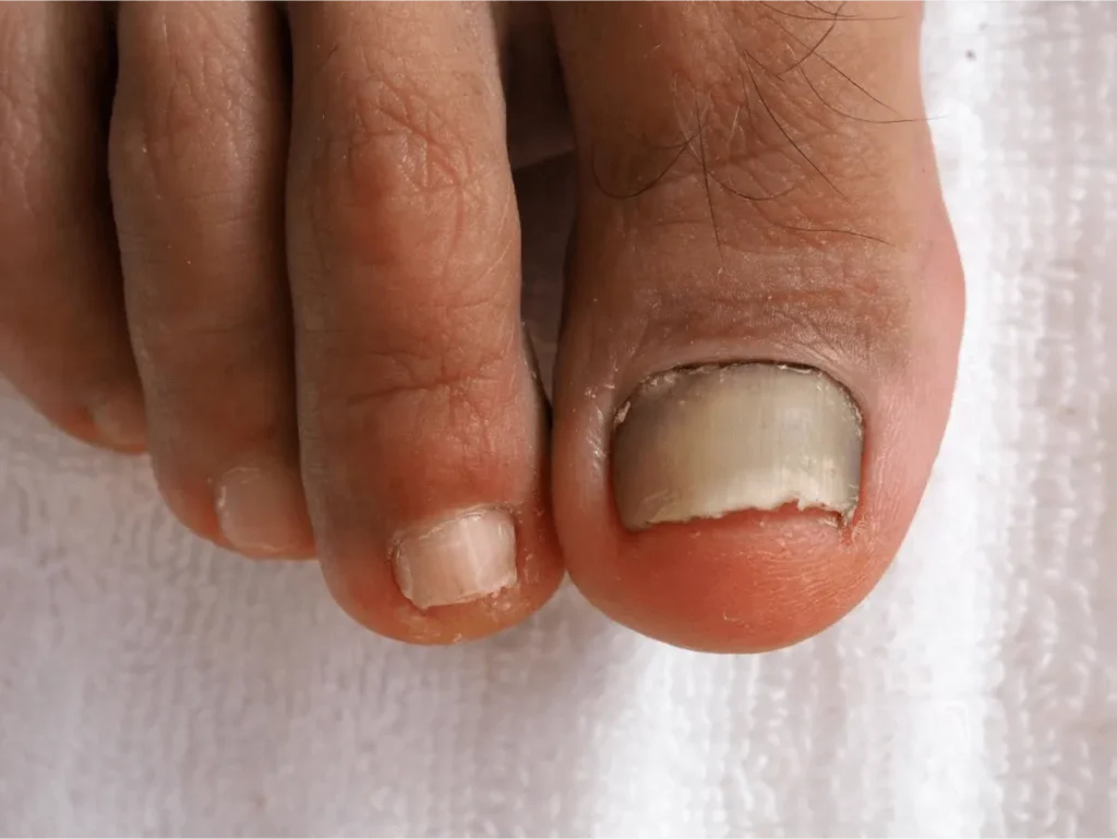 Toenail with discoloration and thickening caused by fungal infection.