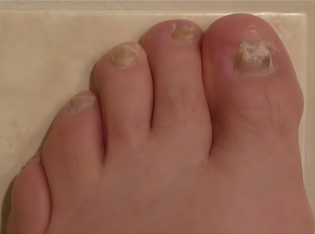 Close-up of toenails affected by severe toenail fungus.