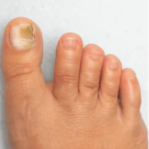 Close-up of a foot with a damaged toenail on the big toe.