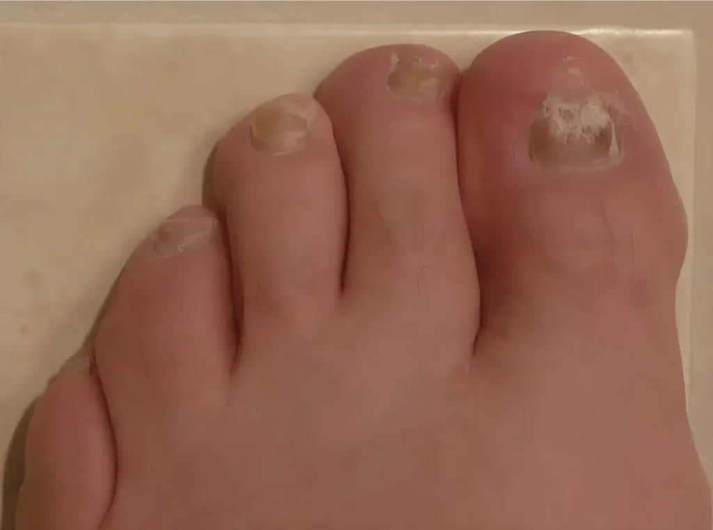 Toenail with fungus infection and discoloration.