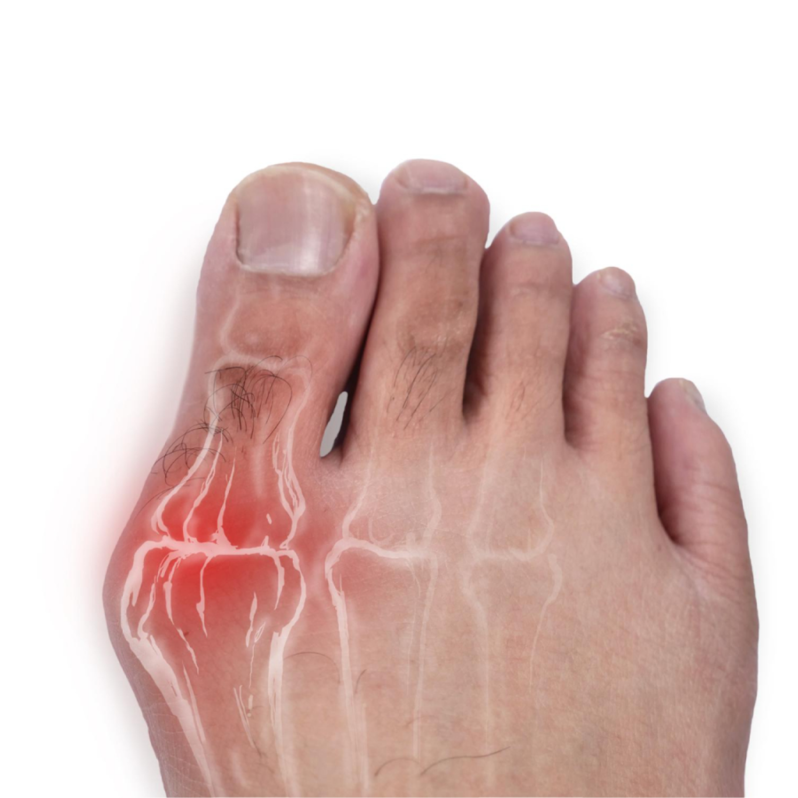 Do I Have a Bunion? Key Signs and Symptoms to Watch For.