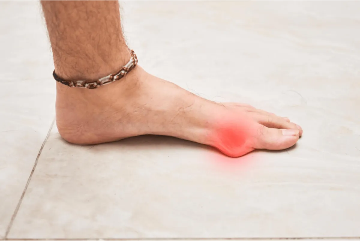 Foot with a red spot indicating Bunion