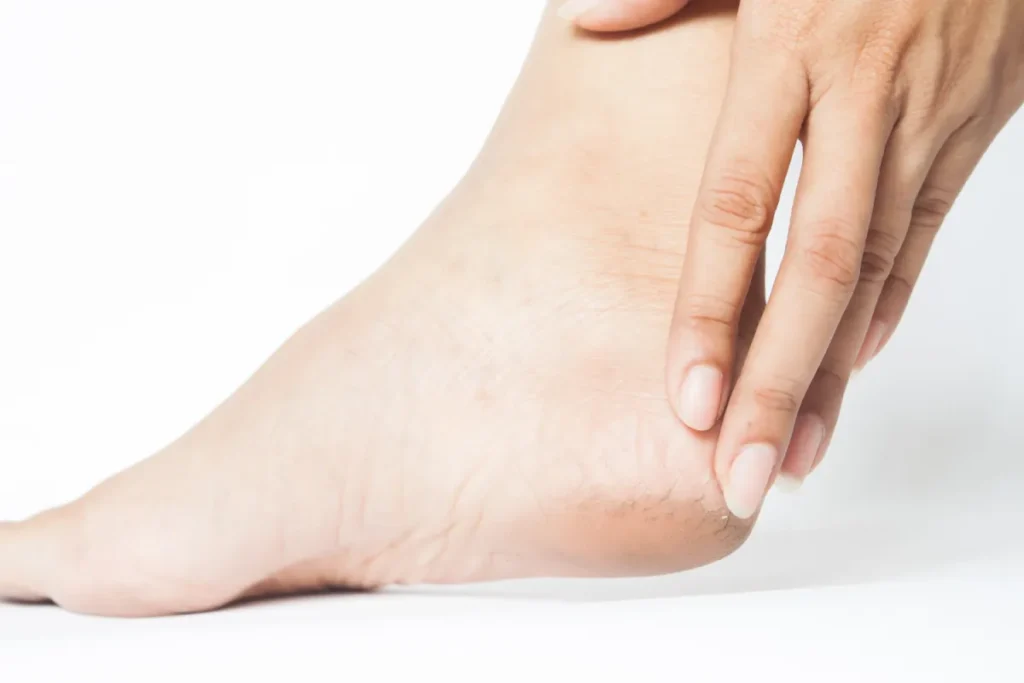 Corn & Callus Treatment for Pain-Free Feet