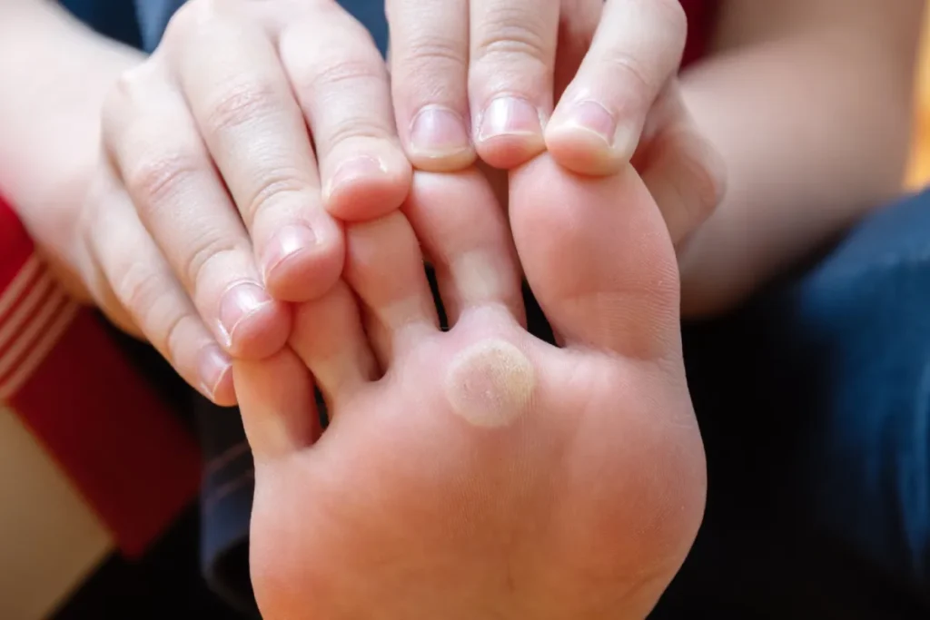 Close-up of foot with corn