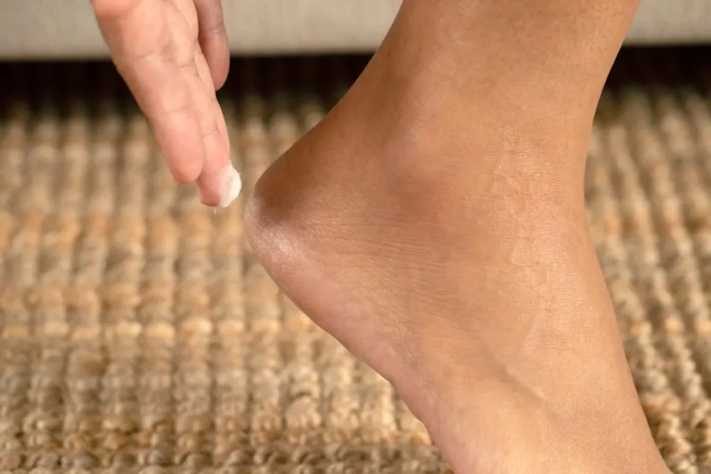 Applying moisturizer to dry heel skin