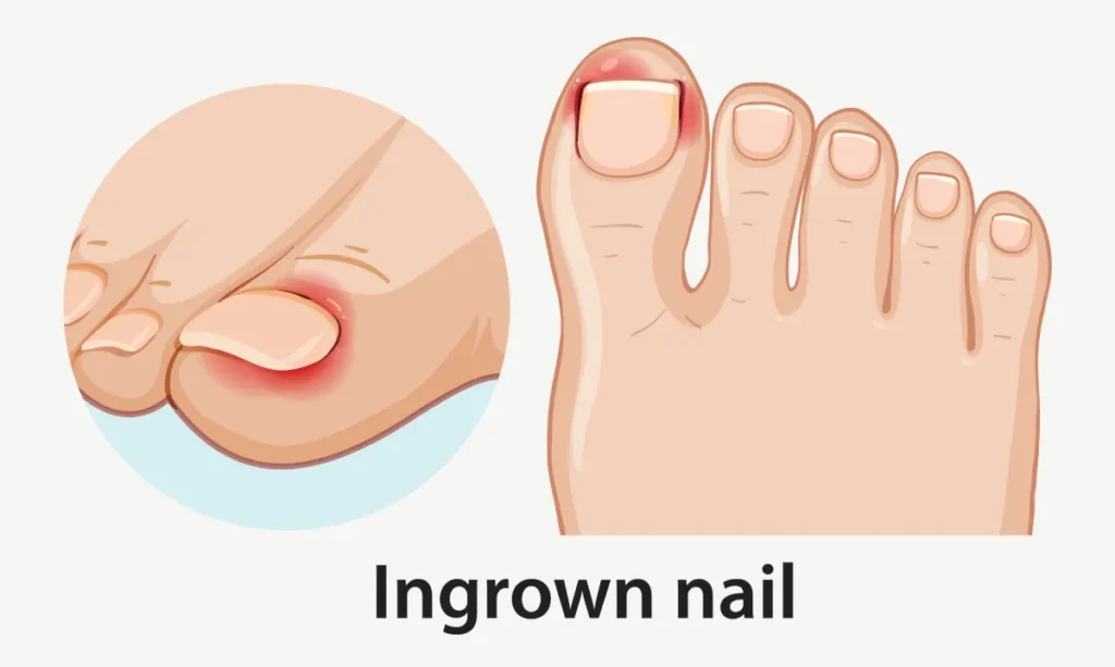 Illustration showing ingrown toenail inflammation