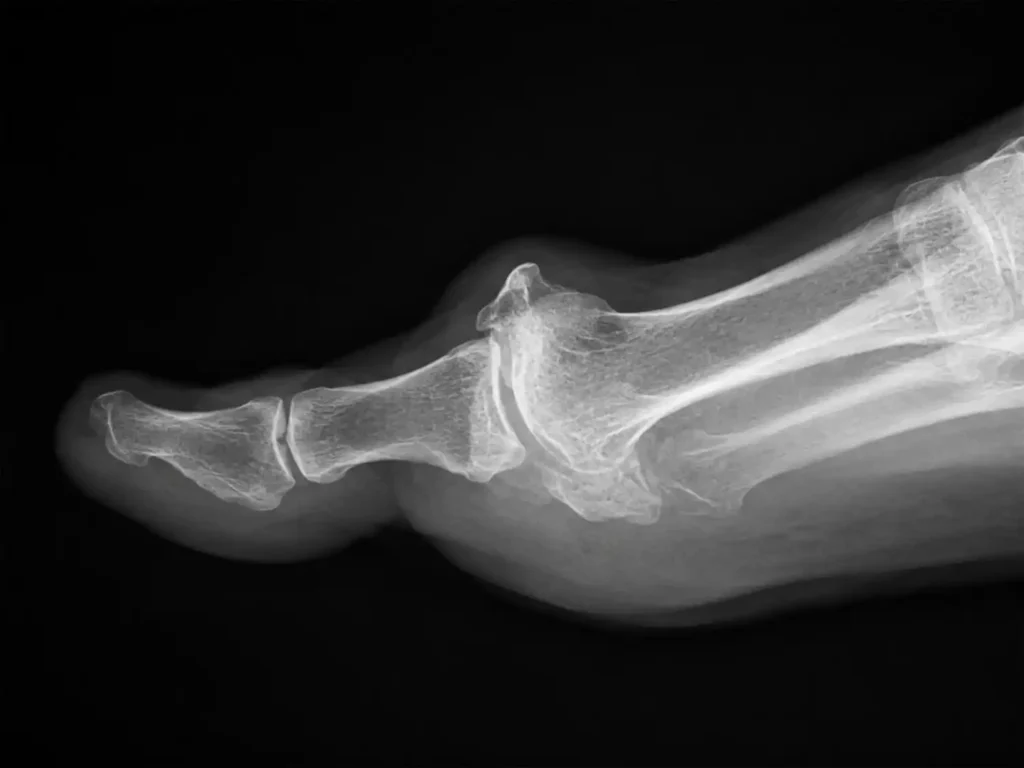 Side-view X-ray showing hallux rigidus bone changes
