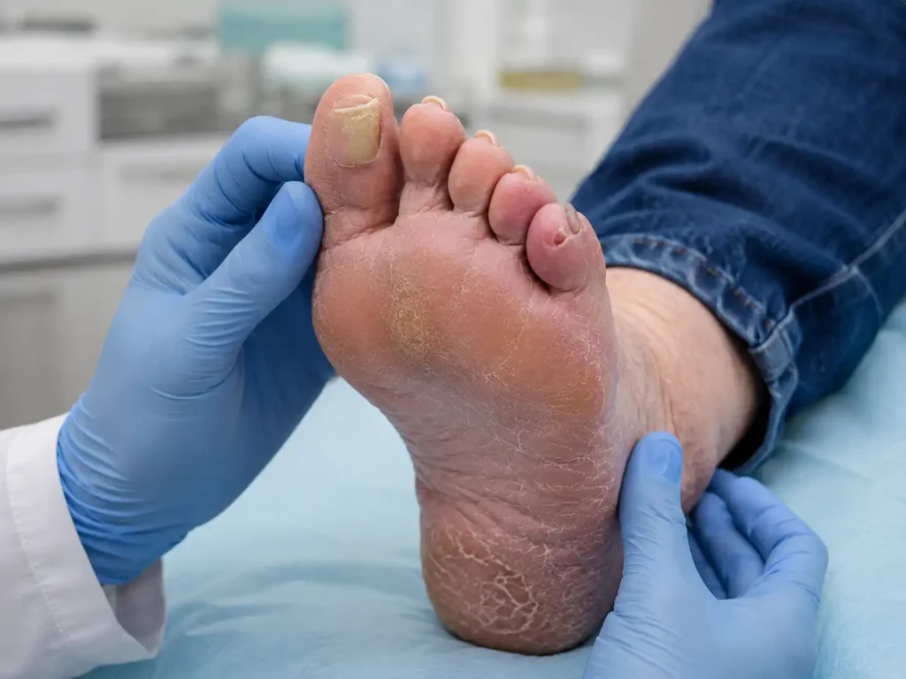 Clinician examining dry, cracked skin on a diabetic foot