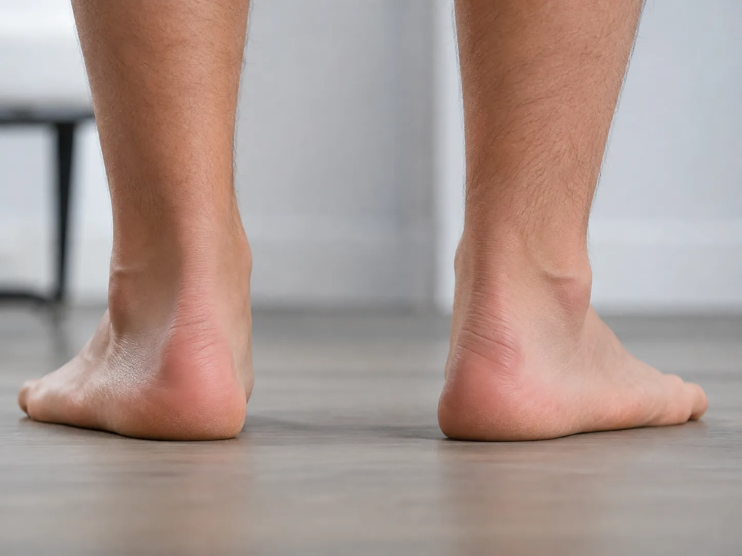 Bare feet showing collapsed arches and overpronation