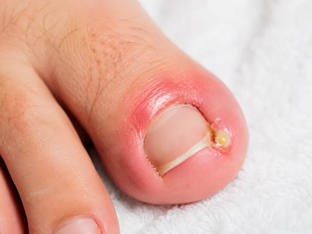 Red swollen toe showing ingrown toenail infection
